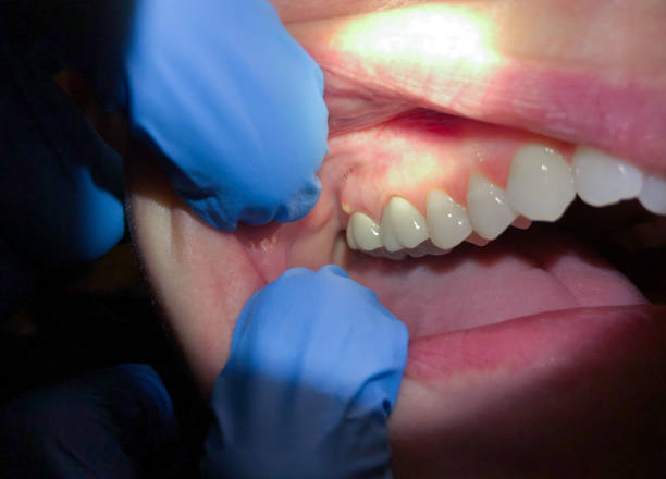 Best Emergency Dental Care for Broken or Chipped Teeth in Brunswick, MD